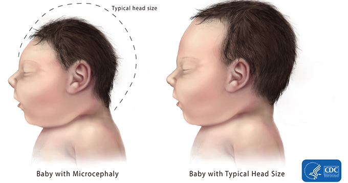 Baby with Microcephaly (Typical head size) and Baby with Typical Head Size