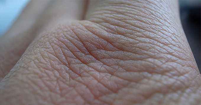Close up photo of a piece of skin on a person's hand