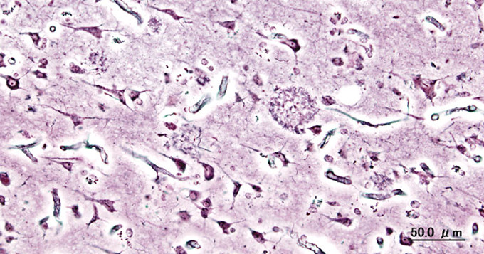 Histopathologic image of senile plaques seen in the cerebral cortex of a person with Alzheimer’s disease of presenile onset. 