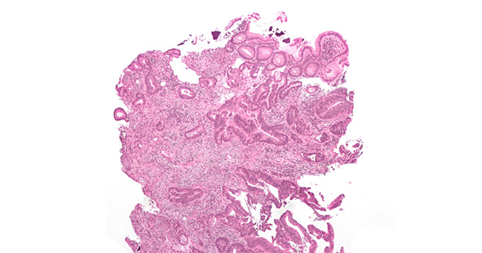 Micrograph of an invasive cecal adenocarcinoma — a type of colon cancer.