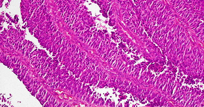 Urothelial papillary carcinoma. Wiki.